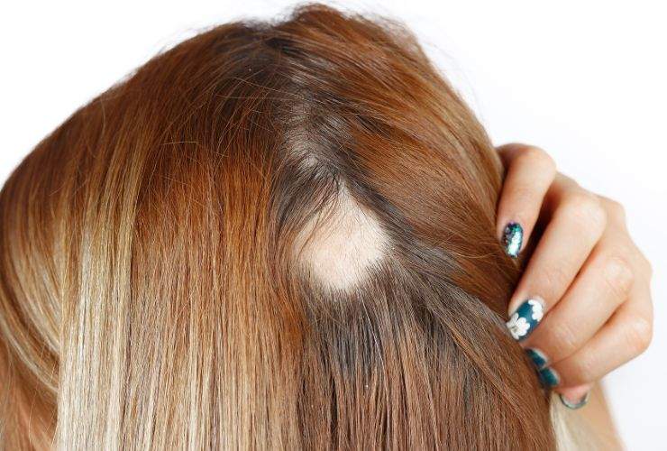 Le varie tipologie di alopecia