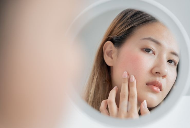 Il problema più comune: l'acne